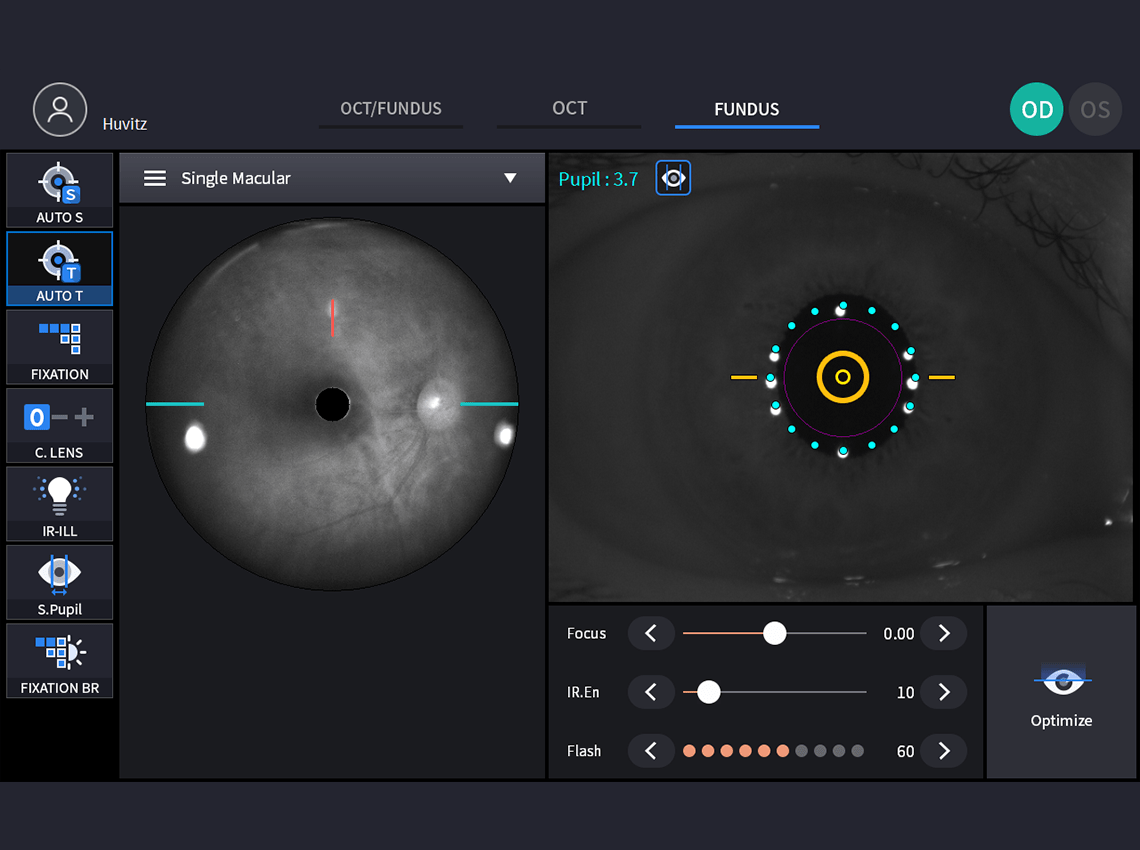 Screenshot of the fundus examination interface on the HFC-1