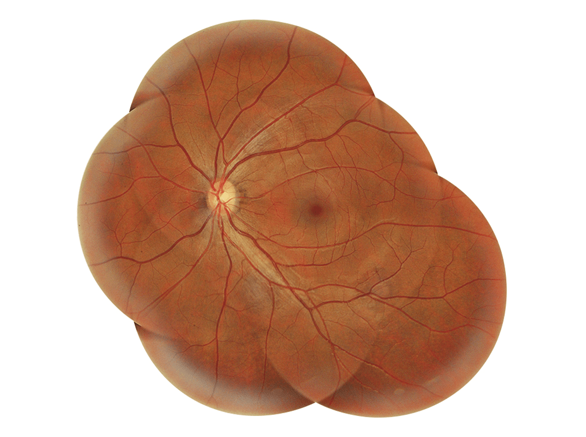 Enlarged photo of fundus