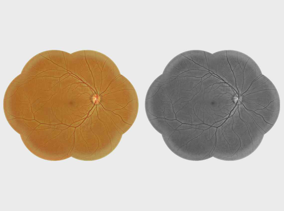 Panoramic Image (Non-Mydriatic Composite Retinal Image)