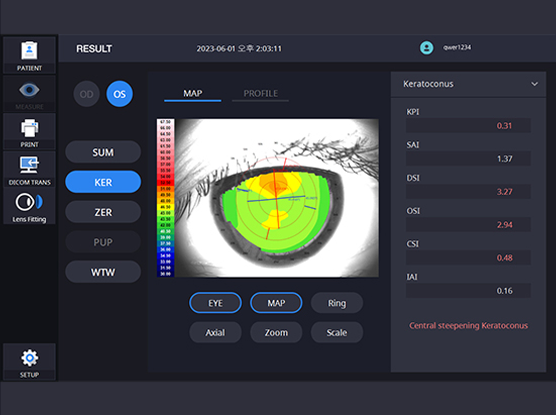 Keratoconus