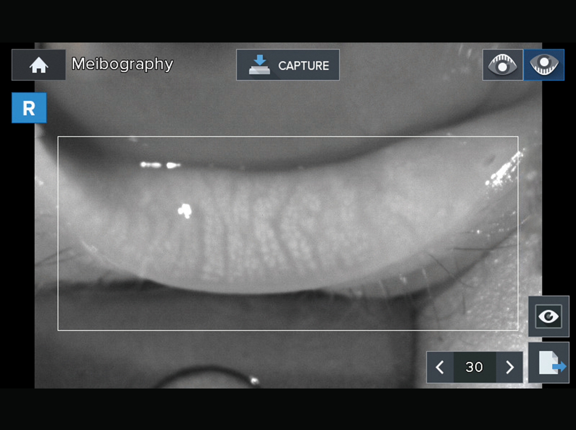 Meibography Measurement