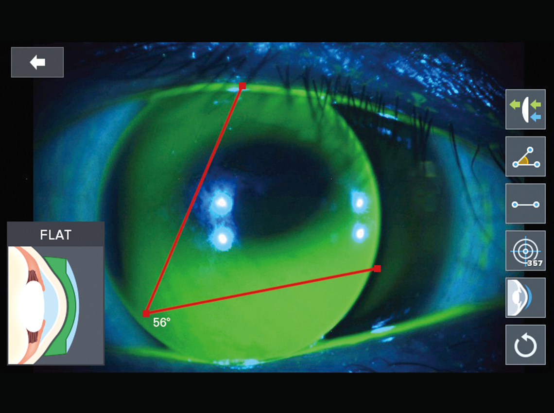 Contact Lens Fitting Assistance Guide