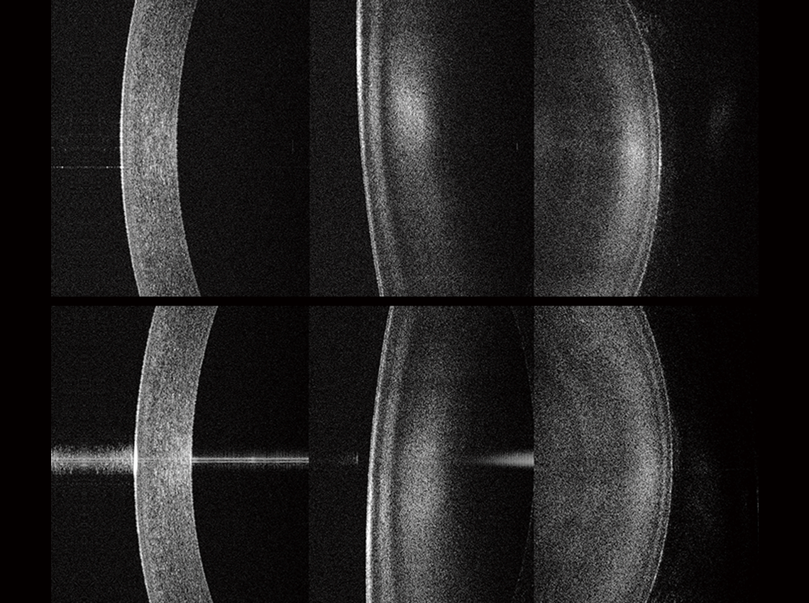 Biometry / LT, Biometry / Cornea - Lens (Front, Rear)