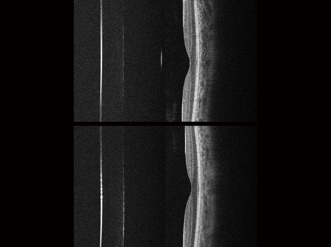 Biometry / AL, Biometry / Cornea - Macular