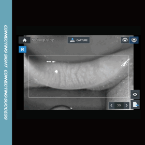 Meibography Measurement