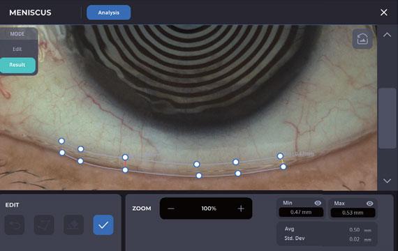 Tear Meniscus Height