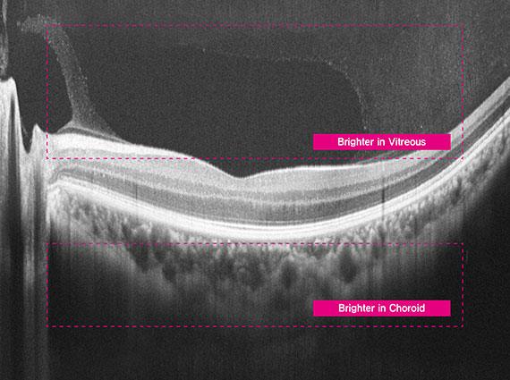 12mm macular line overlap 30, ECI mode