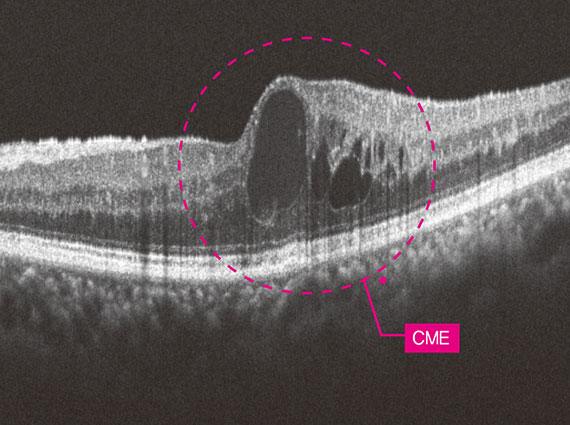12mm macular line overlap 30