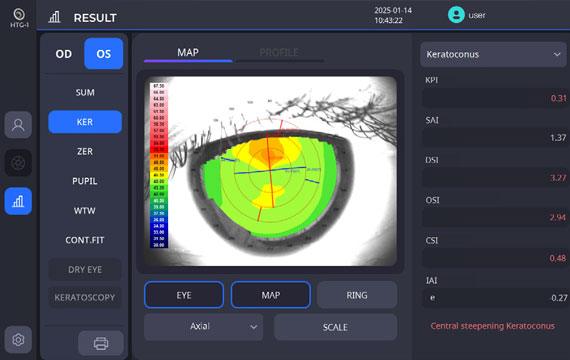 Keratoconus