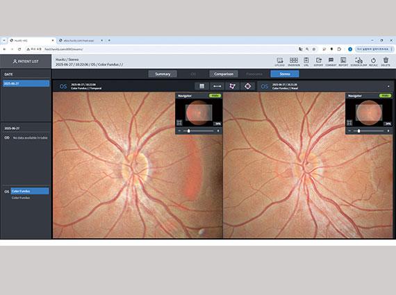 Fundus DISC stereo