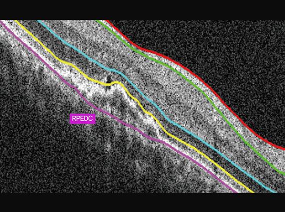 Macular angio 384x384