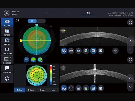 Anterior OCT_Radial