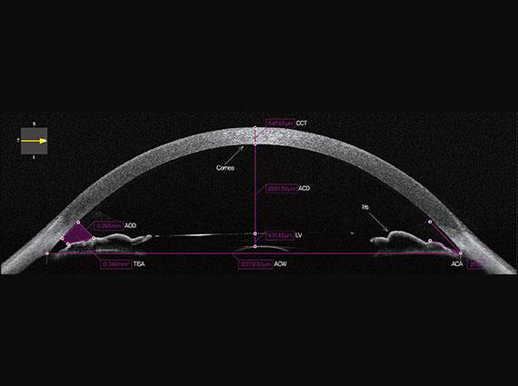 Bio-Anterior Segment Image