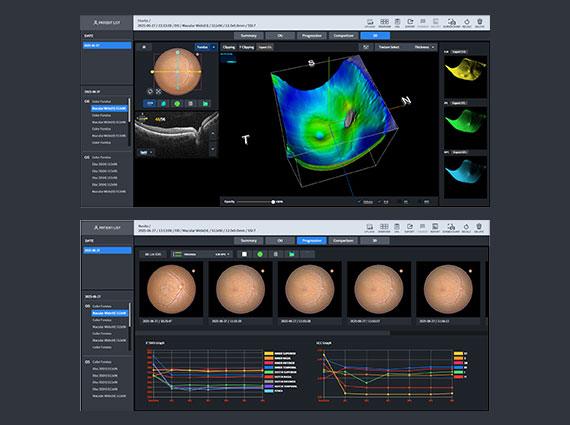 Macular Wide/ 3D, Macular Wide+OCT Progression