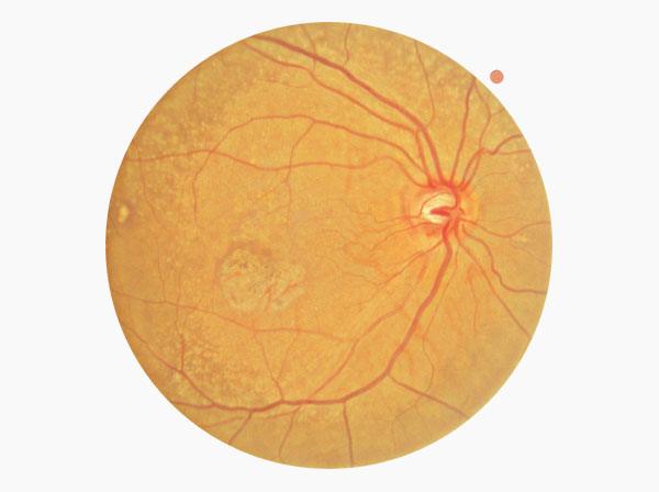 AMD, Fundus single macular, Level 1