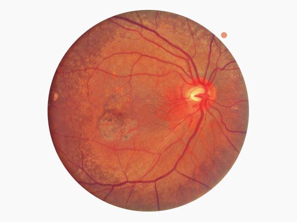 AMD, Fundus single macular, Level 2