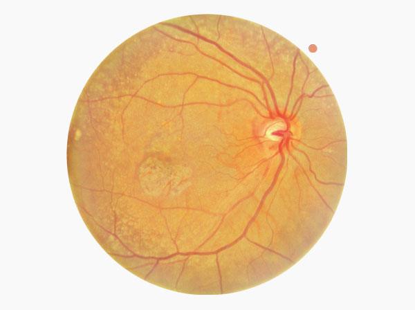 AMD, Fundus single macular, Level 3