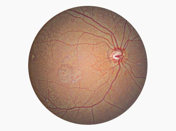AMD, Fundus single macular, Level 4