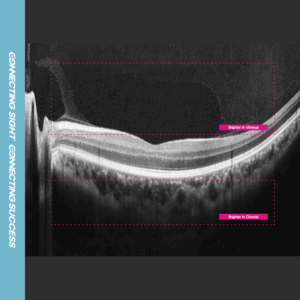 12mm macular line overlap 30
