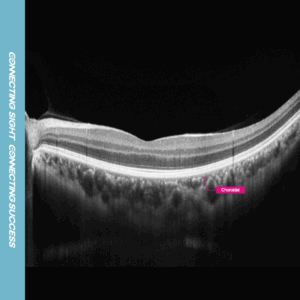 12mm macular line overlap 30