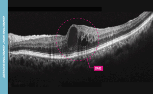 12mm macular line overlap 30_