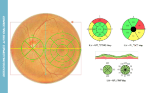 12mm macular wide overlap 10