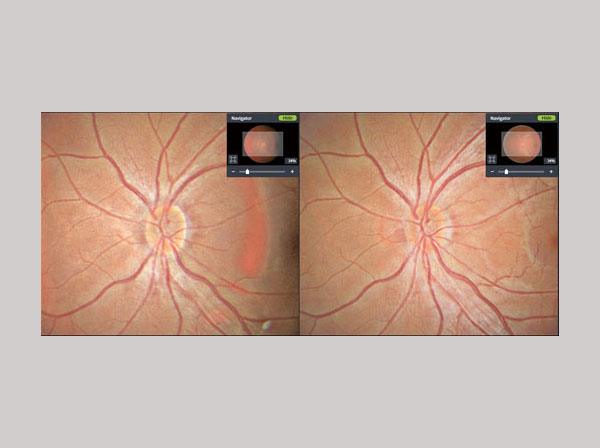 Fundus disc stereo in HIIS-1, level 4