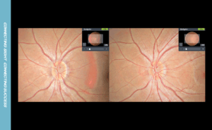 fundus disc stereo level4