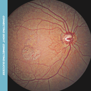 fundus single macular level4