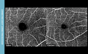 macular angio 512x512, overlap 3, 3x3mm(left) 4.5x4.5mm(right)