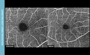 macular angio 512x512, overlap3
