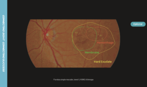 Analysis of 12 lesions using AI