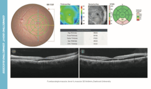Clinical Case Wet Age-Related Macular Degeneration