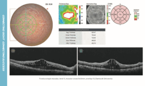 Clinical case Central Retinal Vein Occlusion